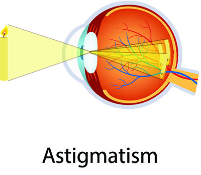 How Light Passes Through an Eye That Has Astigmatism