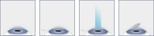 Chart Illustrating the LASIK Surgery Process