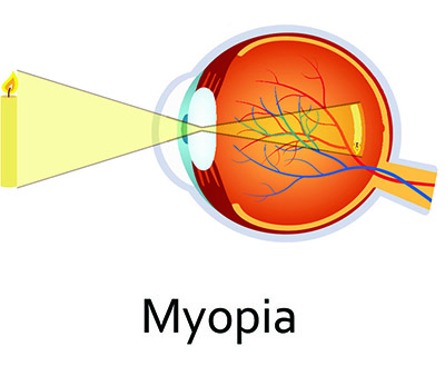 Chart Showing How Light Passes Through an Eye That Has Myopia