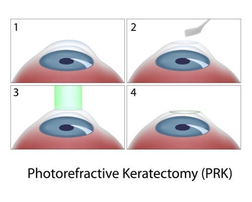 Chart Showing the Steps of PRK